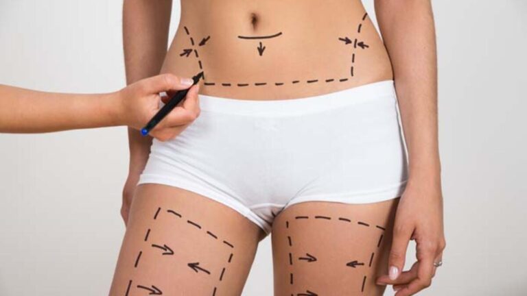 Vücut şekillendirme ameliyatı ile ilgili bilinmesi gereken 10 madde