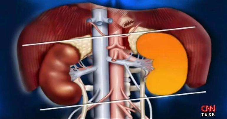Böbrek taşının bu belirtilerine dikkat