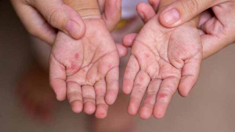 El Ayak Hastalığı Belirtileri Nelerdir? El Ayak Hastalığı Nasıl Anlaşılır? Tedavi Yöntemleri Nelerdir?
