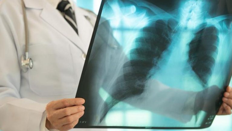 Erken tanı hayati önem taşıyor! Akciğer kanserinin belirtileri ne? Öksürük, göğüs ağrısı, halsizlik, kanlı balgam… –